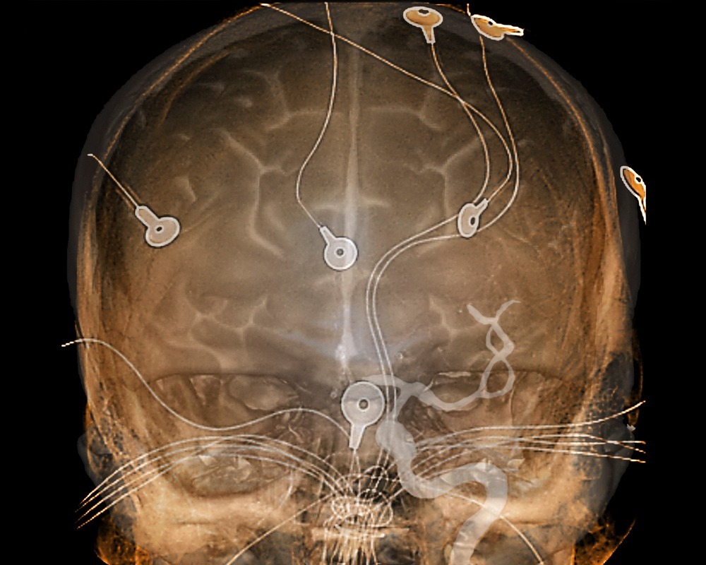 뇌혈류검사 (Tanscranial Doppler Study) 첨부 이미지